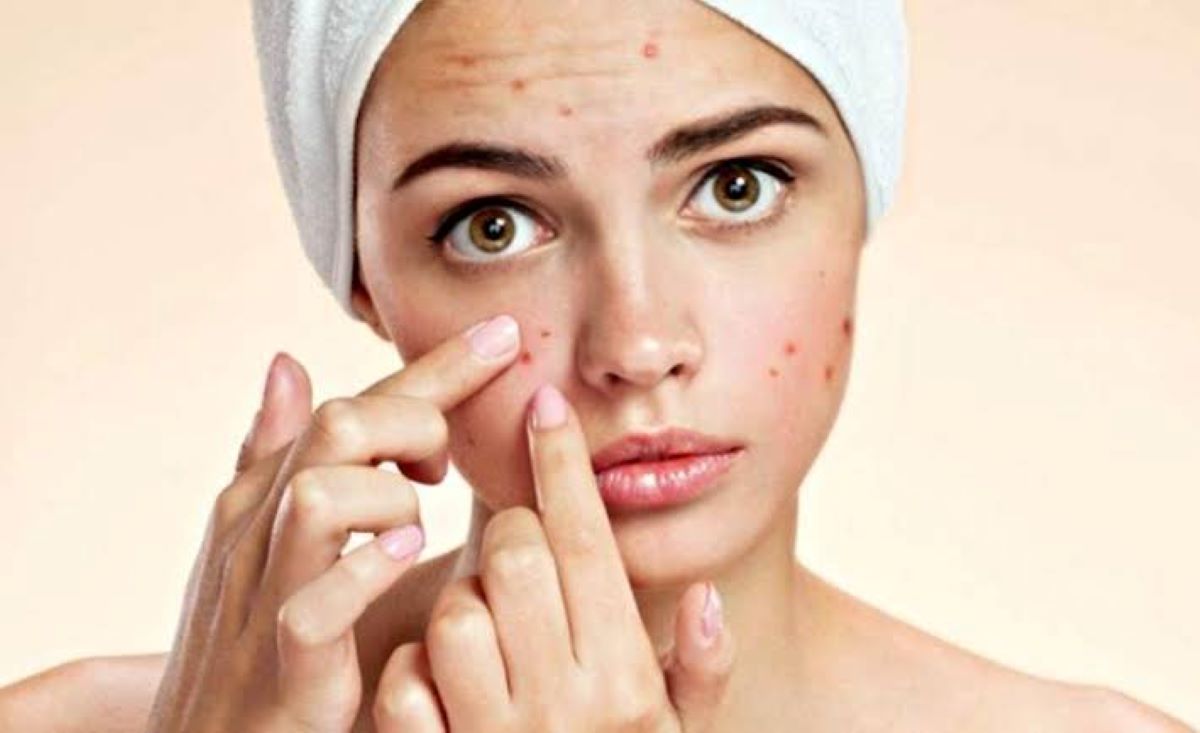 Saúde: veja algumas dicas para se livrar da acne!
