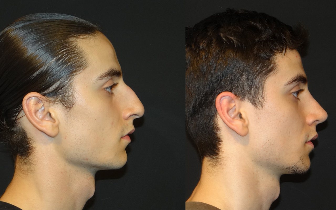 Rinoplastia Masculina: como funciona a cirurgia de nariz para os homens? -  Guia dos Solteiros